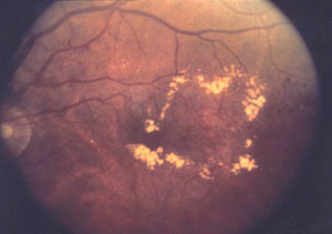 exudados duros en edema macular